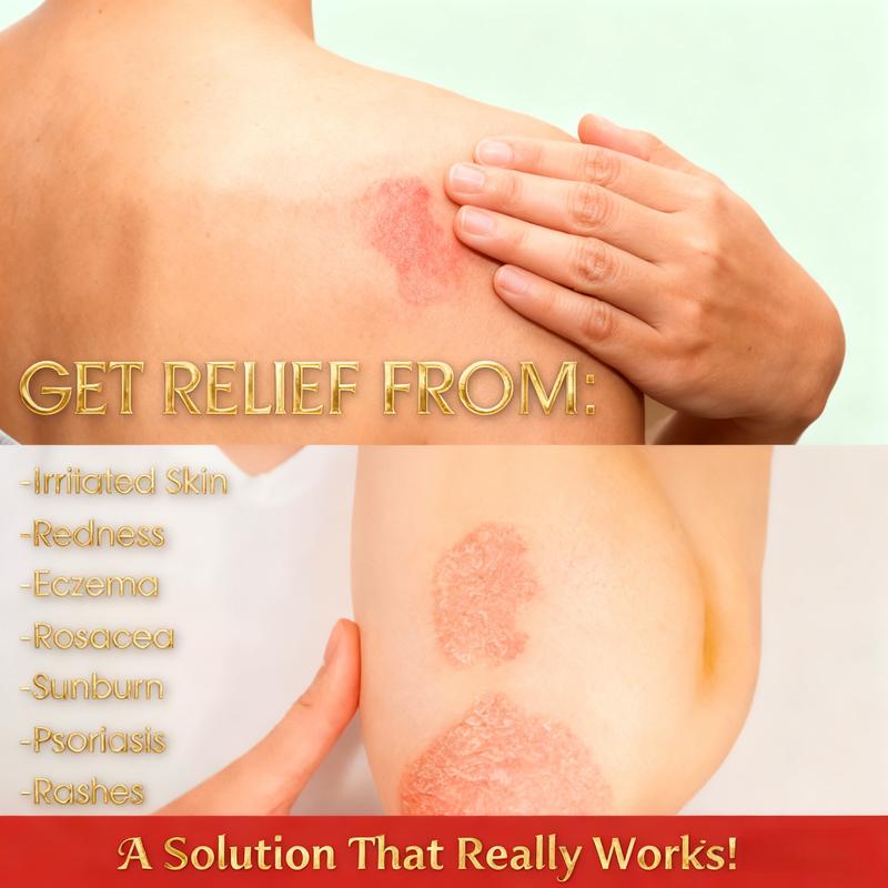 Herbal Sensitive Skincare Cream with Honeysuckle & Peppermint 30g Natural Soothing Ointment for Eczema Psoriasis & Itching Gentle for All Ages