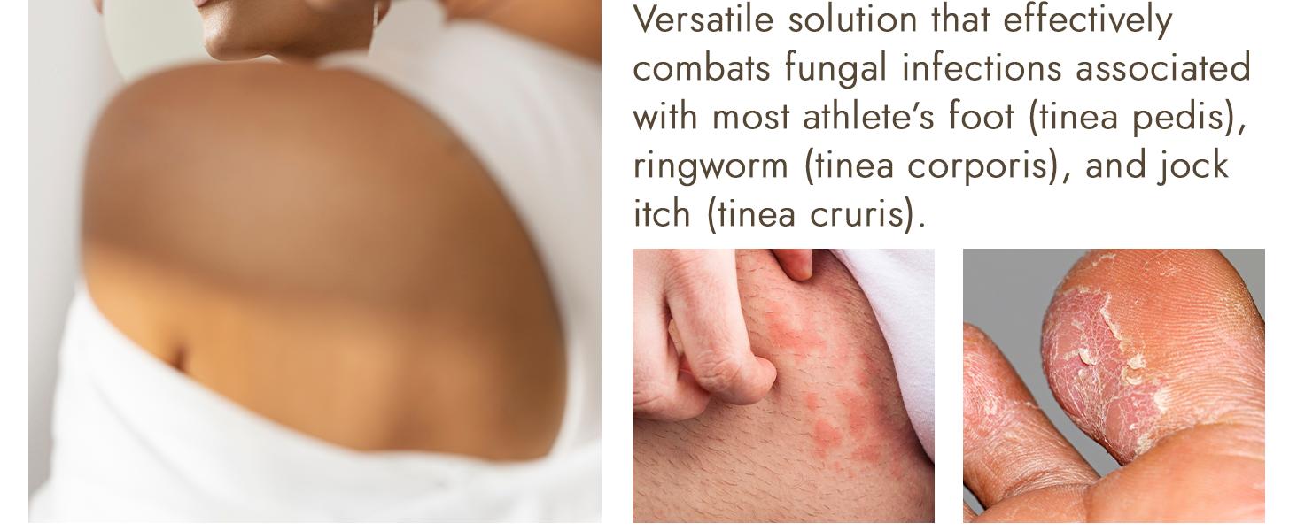 Antifungal Soap | Medicated Jock Itch Treatment, Fights Ringworm & Athlete's Foot | Soothing Tea Tree & Eucalyptus | 1% Tolnaftate for Effective Relief | Travel-Friendly with Soap Case