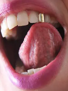 HIPHOP dental braces Retainer braces for single teeth, a best-selling accessory, a fashionable item that showcases elegance, made of edible material