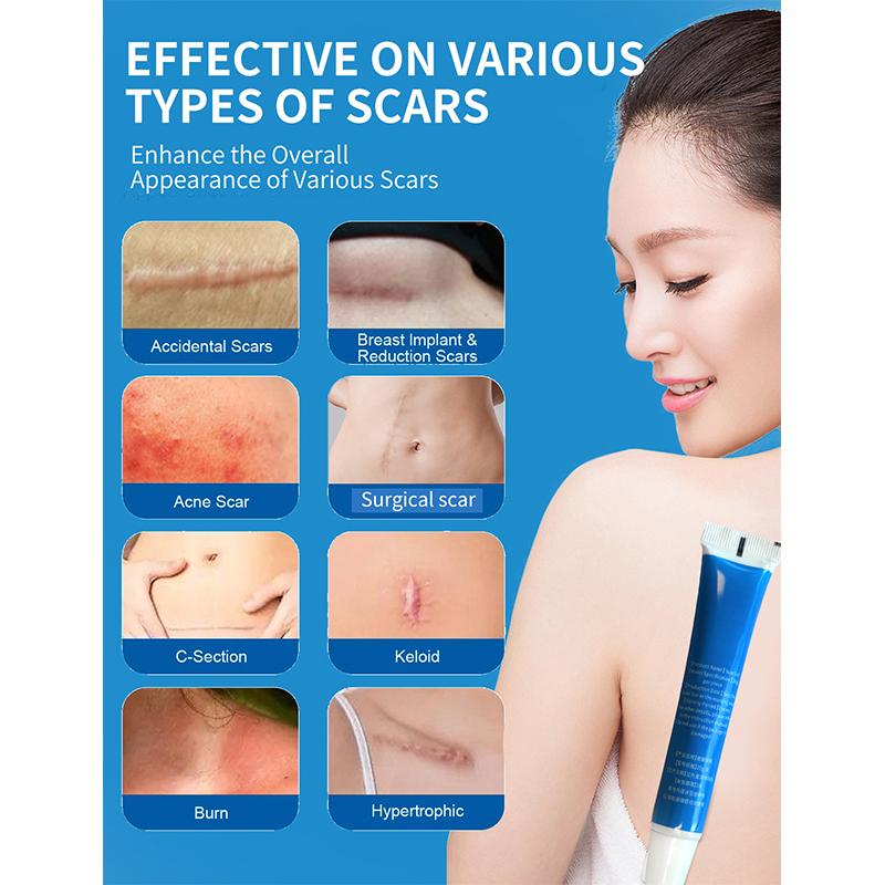 ANXINKANG Silicone Scar Gel, reduces the appearance of new and old scars from burns, stretch marks, surgery, trauma, keloids, etc., 0.70 oz (20g)