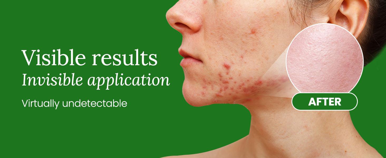Troubless Invisible Pimple Spot Patch - 96 Ultra Thin Acne Patches - Easy Peel - 2 Sizes Skincare Skin Repair Troubless Invisible Pimple Spot Patch - 96 Ultra Thin Acne Patches - Easy Peel - 2 Sizes Skincare Skin Repair