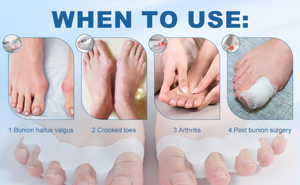 Toe Separators for Women & Men - Bunion Corrector, Hammer Toe Straightener, Relieves Foot Pain (2 Pairs, White + Beige)