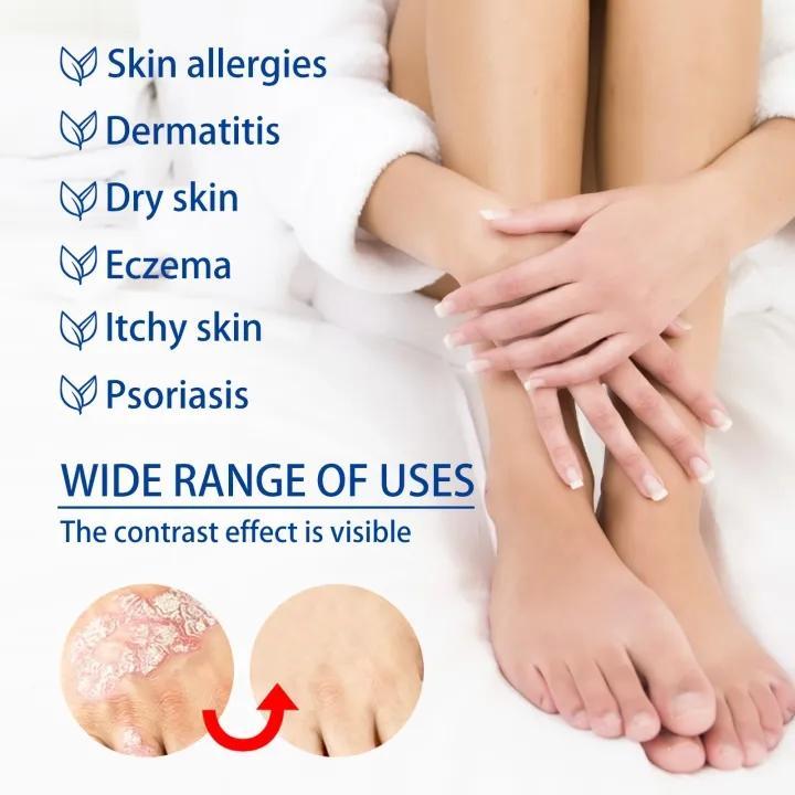 Cream for Eczema & Psoriasis,All-Natural Soothing Cream  – Best Gift,Herbal Relief for Dry, Itchy, Sensitive Skin , Anti-Bacterial Skin Defense (Hydrating, Safe for All Ages | 20g) Treatment