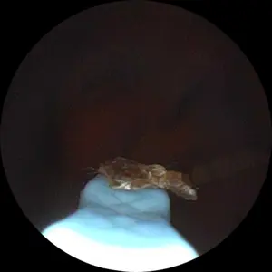 [Valentine's Day Gift] 1080P HD EarWax Removal Tool with Camera 6 Ear Spoons Set Rechargeable USB Battery Dual Power Safe Ear Care Gentle Round Handle Version