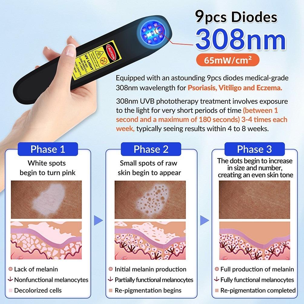 ZJZK 9 Diodes 308nm UVB Excimer Phototherapy Device, 65mW/cm² High Energy Density, Handheld Blue Light Skin Treatment, Targeted Therapy for Vitiligo, Psoriasis, Eczema, Atopic Dermatitis, Portable Home Use for Skin Disorders