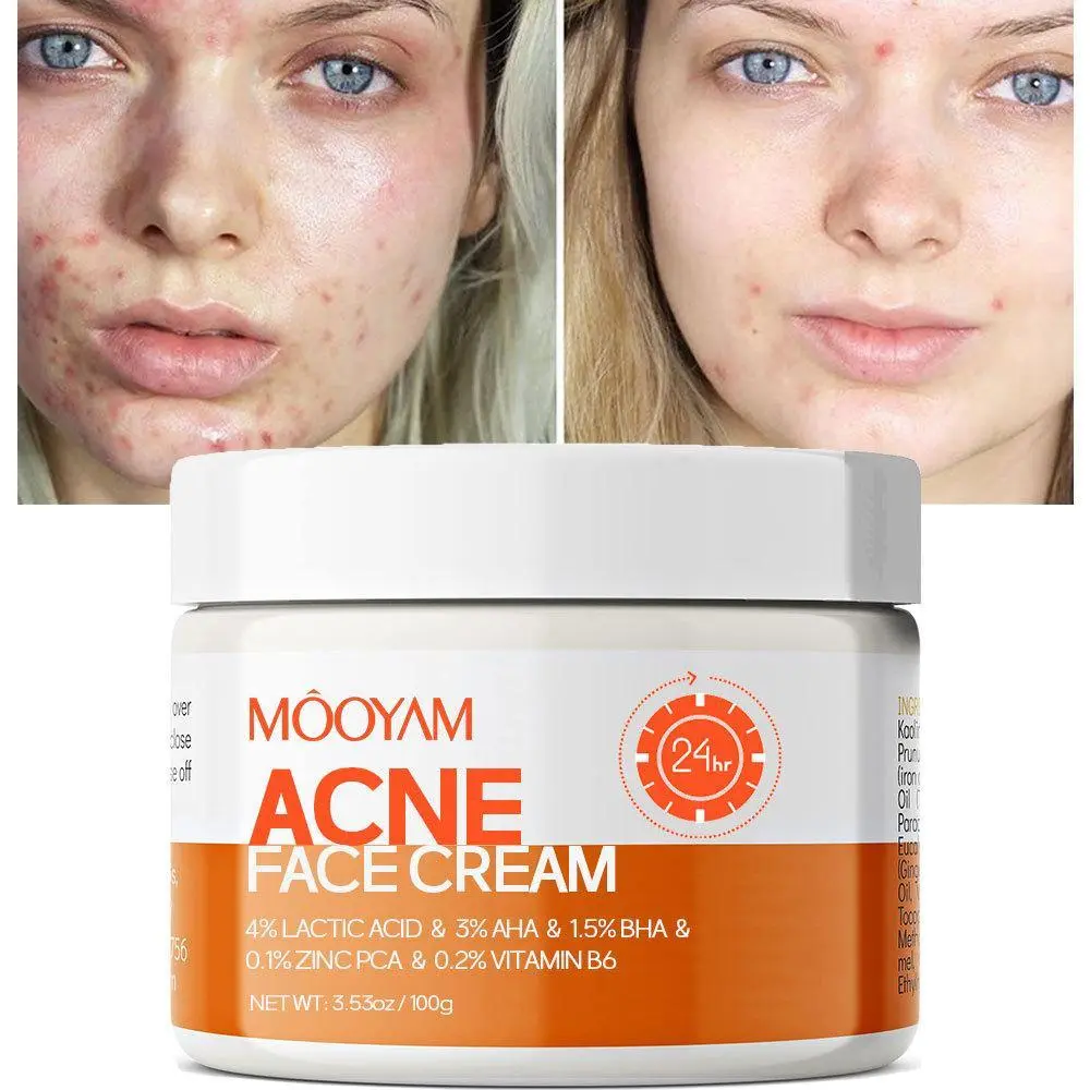 Teen Pimple Acne removal Cream 100g Spot Remover Skin Care Solution