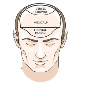 Centrifugal Cicatricial Alopecia or CCCA Understanding and Solutions by Certified IAT Trichologist