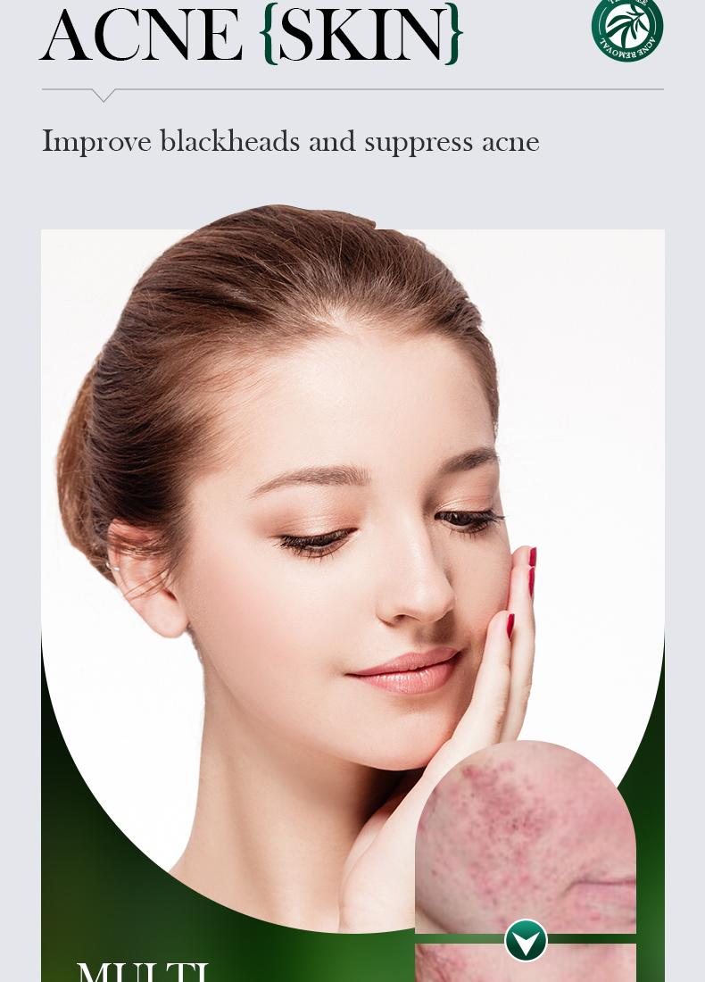 Tea tree acne oil control essence, lightens acne marks, natural cleansing and acne removal, removes blackheads, repairs skin essence