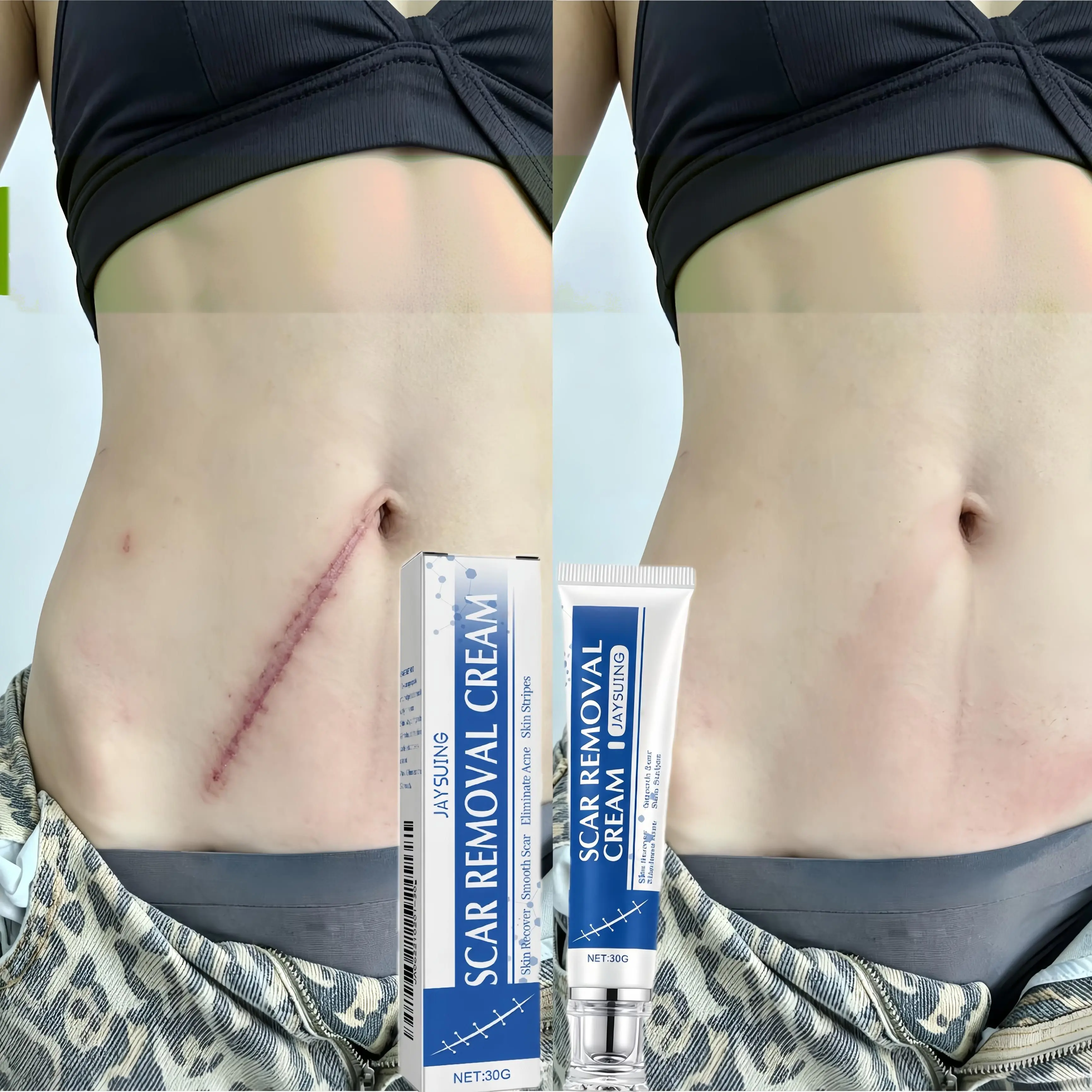Professional Scar Removal Gel- Scarremovaltreatment for keloids, C-sectionS, surgeries,burns, acne andmore.Body cream, milk - body care cream