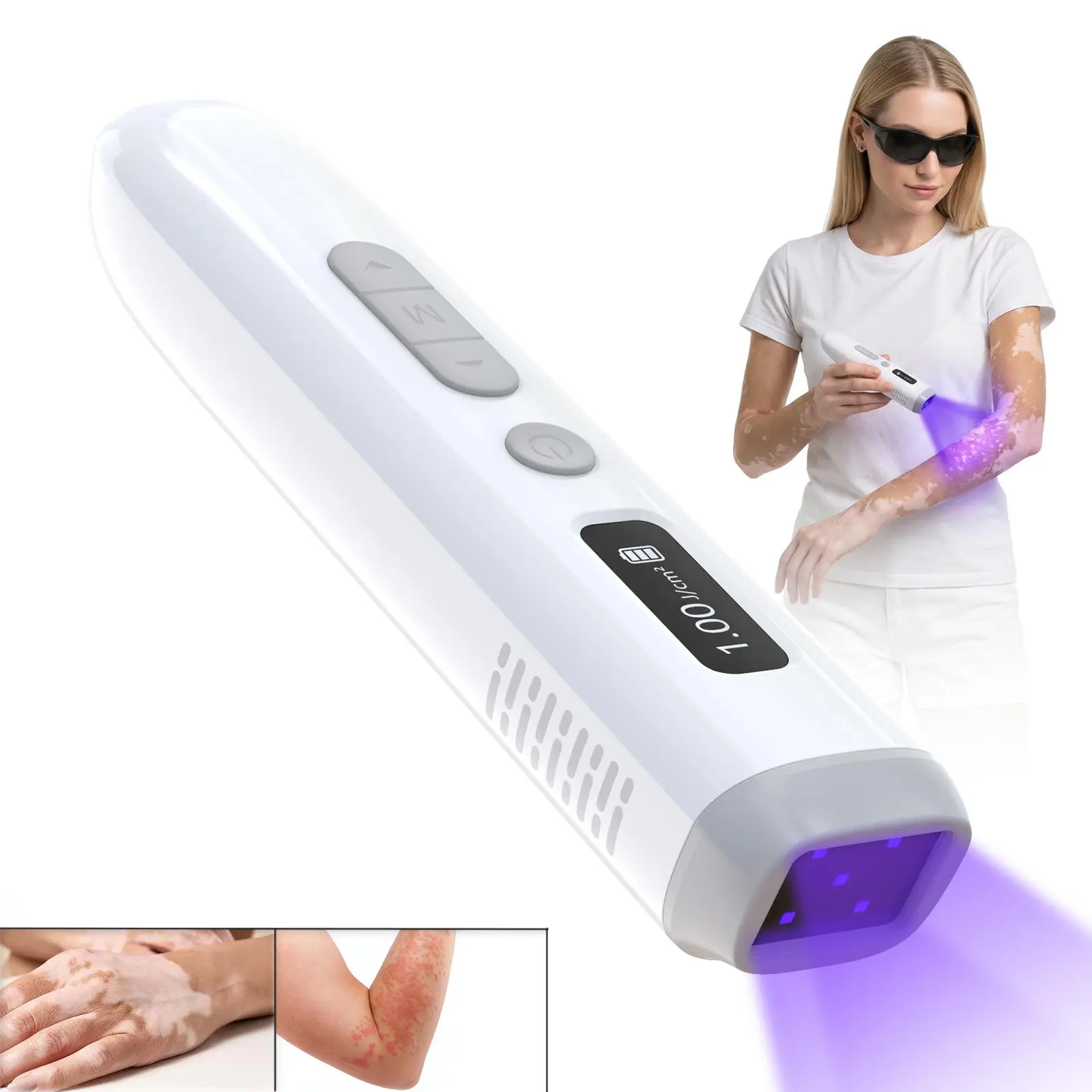 Handheld 308 nm UVB Light Therapy Device - Adjustable, Compact Portable Daily Skin Care Tool for Vitiligo, Psoriasis Treatment, Medium-Wave UV Appliance