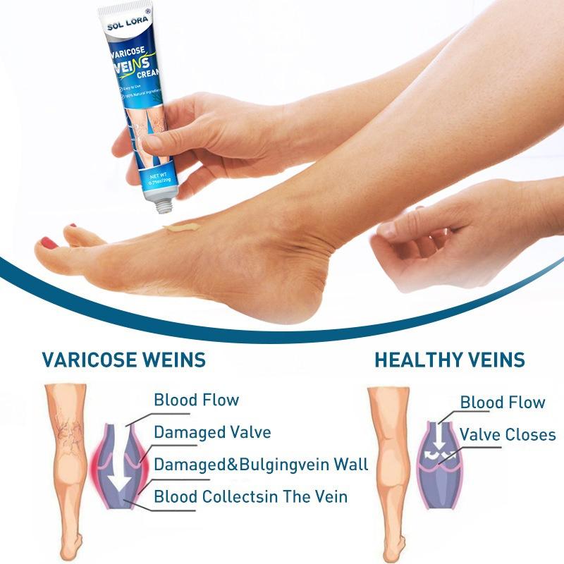 SOL LORA Varicose Veins Cream for Varicose Veins Relief of Bulging Blood Vessels in Legs - Hydrating Moisturizer for Smoother Skin & Improved Circulation