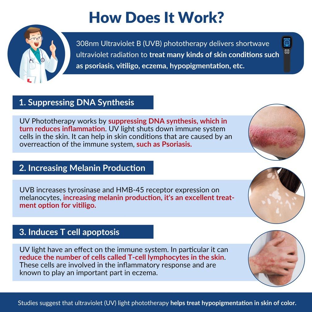 ZJZK 308nm Excimer Phototherapy Device with 49 Diodes, Blue Light Therapy for Vitiligo, Psoriasis, Eczema, Atopic Dermatitis, Fungal Skin Disease, Hypopigmentation, Safe Targeted Home Use, Fast Recovery, Prevent Recurrence, Portable Handheld