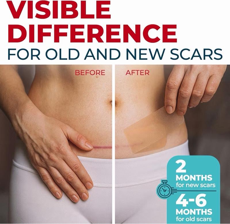 Medical Grade Silicone Scar Tape - 1.6”x150” - Visible Difference on Keloid &...