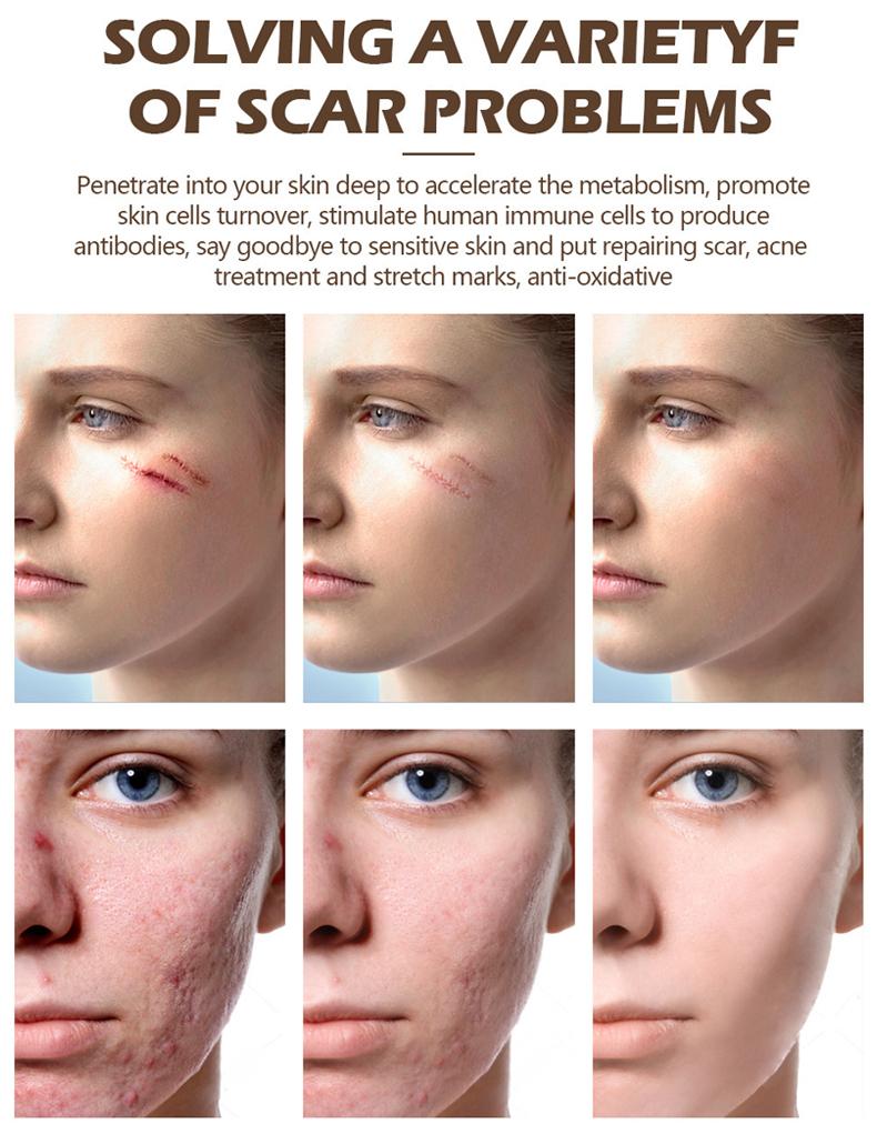 FATAZEN Acne Scar Repair Cream Centella Asiatica Fade Scars, Acne Marks, Brightens Skin Tone Skin Repair Skincare FATAZEN Acne Scar Repair Cream Centella Asiatica Fade Scars, Acne Marks, Brightens Skin Tone Skin Repair Skincare