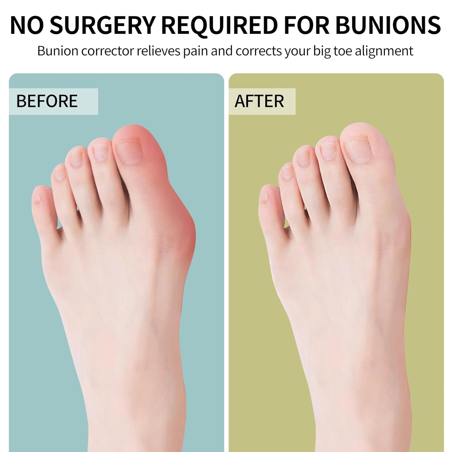 Unisex Bunion Corrector: Adjustable Big Toe Relief Splint and Hammer Toe Corrector—Comfortable, Effective, and Dual-Action.