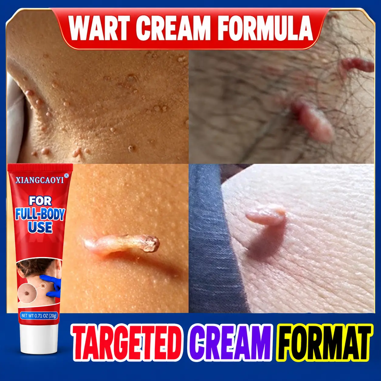 Wart Removal Cream, 20g Milky Formula for Flat Warts, Filiform Warts and Small Raised Bumps, Precision Nozzle for Neck, Underarms, Hands and Feet, Compact Topical Tube for Focused Application at Home or While Traveling with Ease
