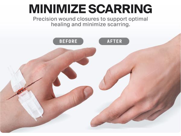 SURVIVEX Wound Closure Kit - Non-Invasive Skin Healing Solution for Cuts & Wounds - Gentle, Adjustable Tension, No Scarring, Easy Removal - All-in-One Emergency Healthcare Aid