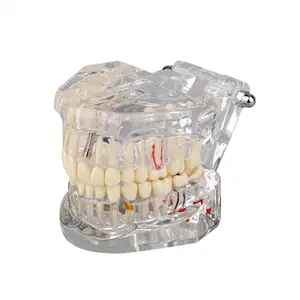 Transparent Pathological Teeth Model with Dental Implant Bridge Dental Teaching Model for Patients and Dental Students