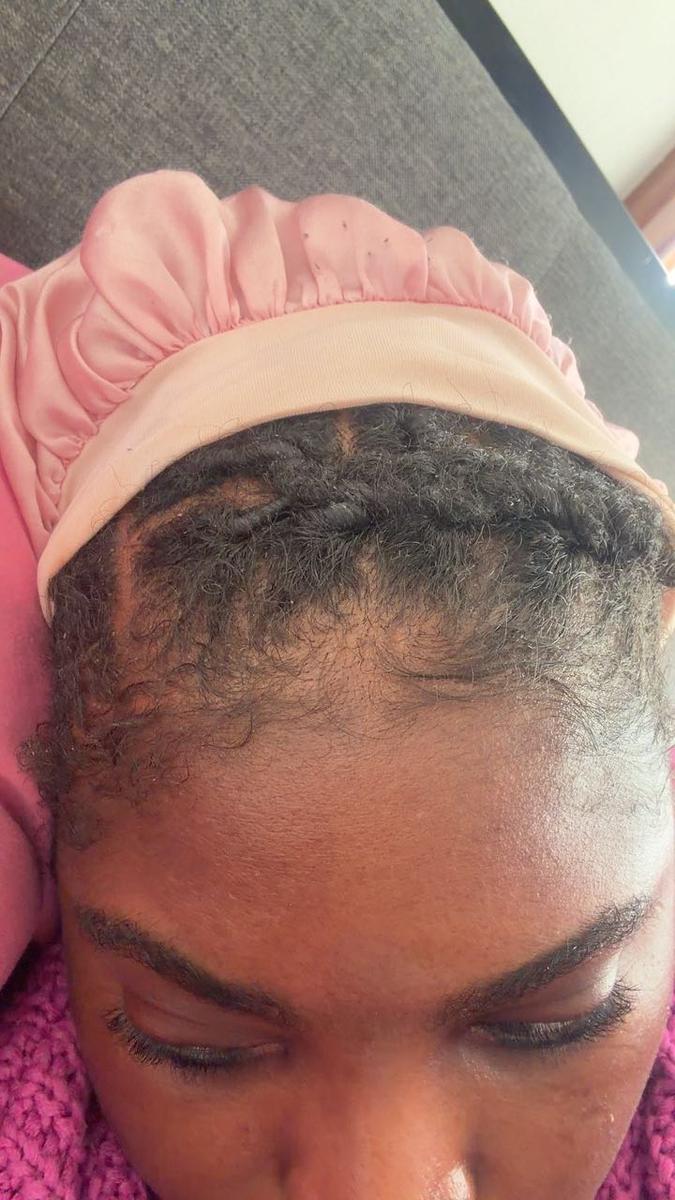 Item: 1box+microneedle roller