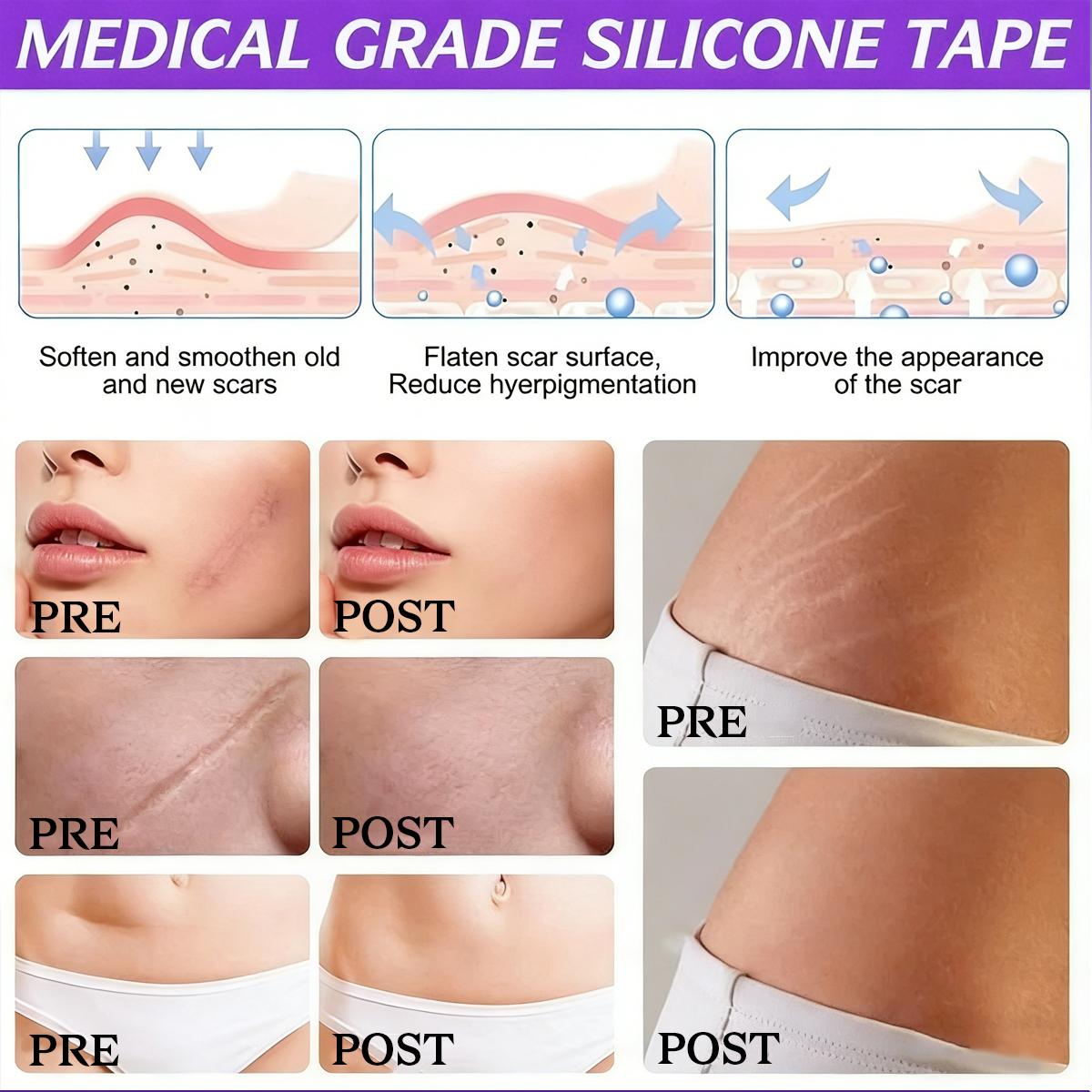 Silicone Scar Tape,Silicone Scar Sheet Silicone Removal Strips(1.6"X 59" Roll-1.5M) For Surgical Scars, Reusagble Effective Removal Silicone Scar Removal Strips For Surgical,Tummy Tuck C- Section