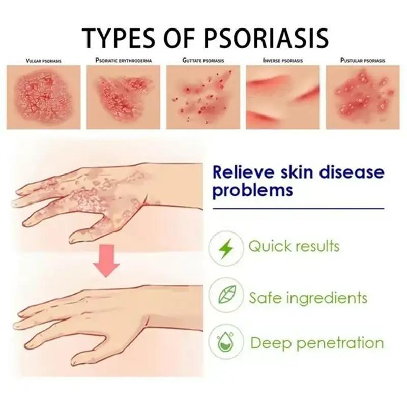 【Buy 1 Get 1 Free】MAYLOR Natural Soothing Cream for Eczema and Psoriasis Relief with Centella and Salvia, Gentle Moisturizing and Antimicrobial Care for Sensitive Skin, Suitable for All Ages, 30g