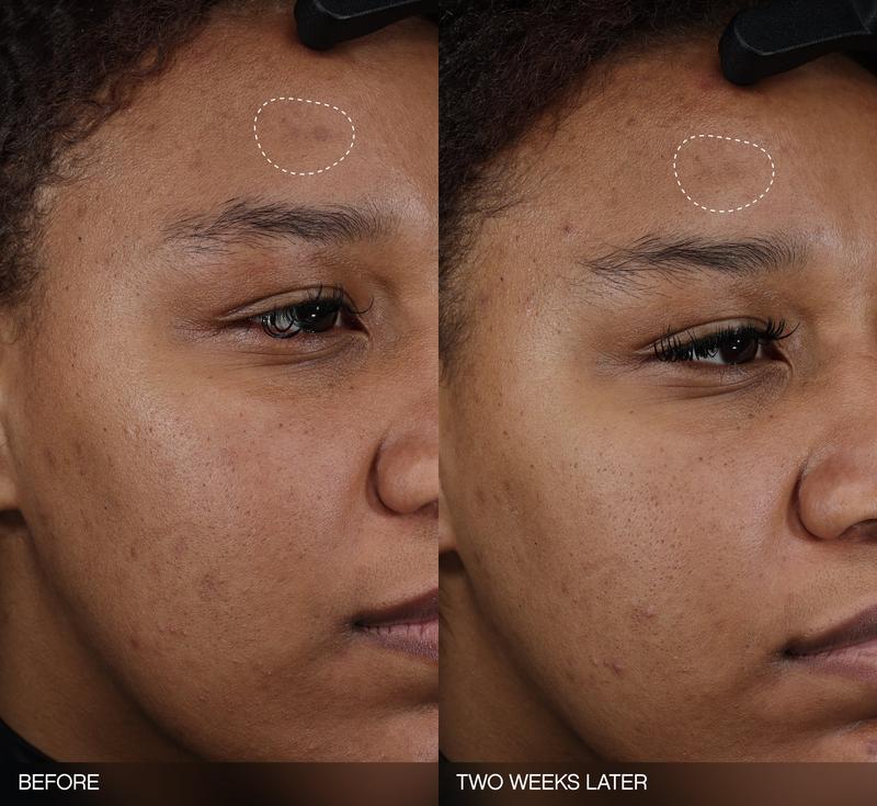 Faded Dark Spot Patches -  Brightening Patches for Hyperpigmentation + Post Breakout Marks