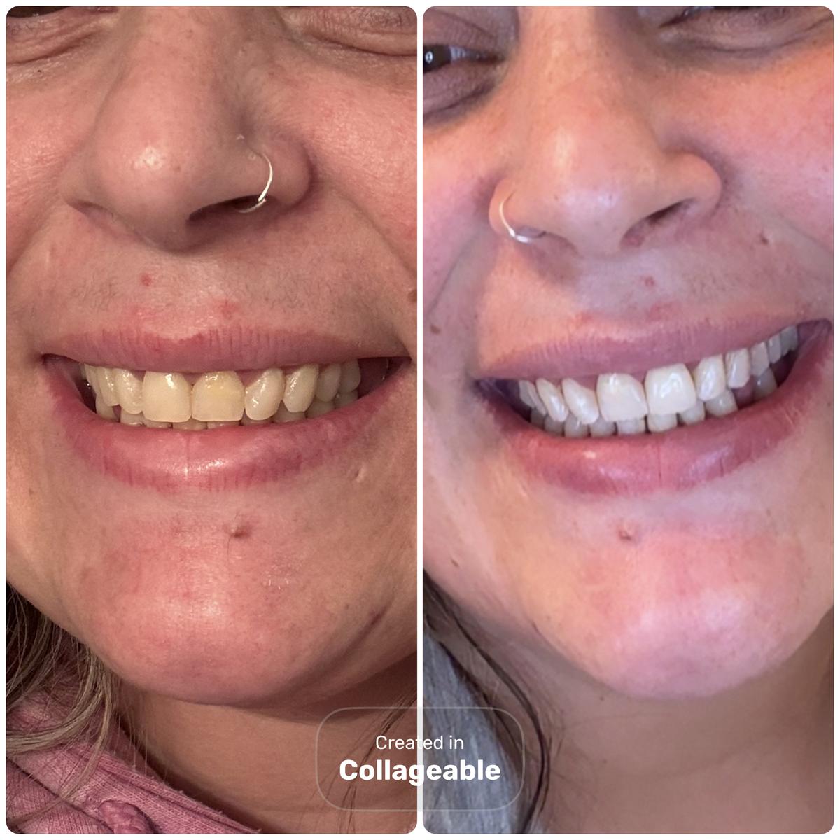 Item: 14 Strips (7 Sessions) + Cheek Retractor