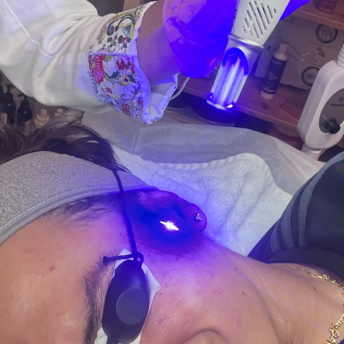 Laser no ablativo para acne Laser no ablativo para acne
