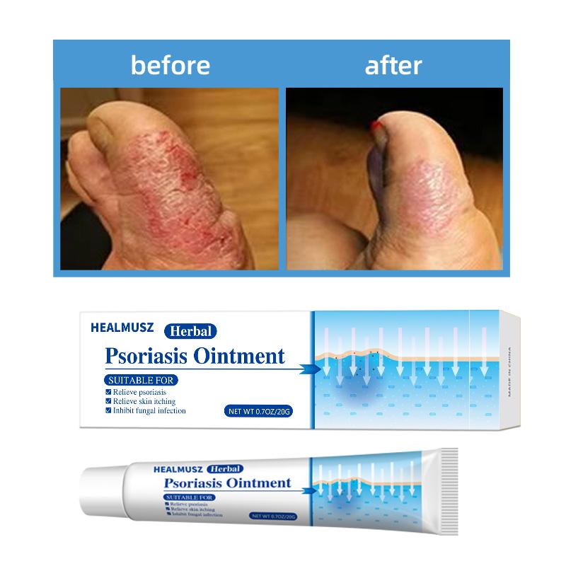 Herbal Antifungal Cream – Soothes Itching from Psoriasis, Eczema, Ringworm, Jock Itch, Athlete’s Foot, Toenail Fungus, Yeast Infection & Tinea – 100% Plant-Based, Steroid-Free – Restores Dry Cracked Skin & Protects Against Recurrence