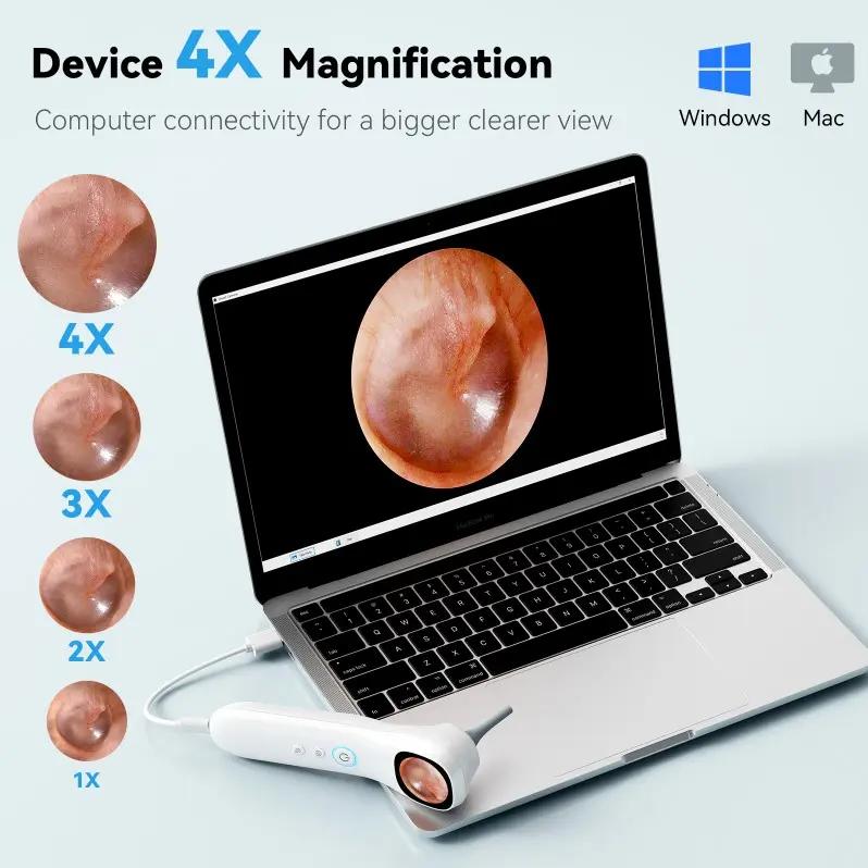 1080P HD Visual Ear Cleaner, 5-in-1 Smart Ear Detector with Built-in IPS Screen, Plug-and-Play Video Otoscope for Ear, Nose, Oral & Skin Observation