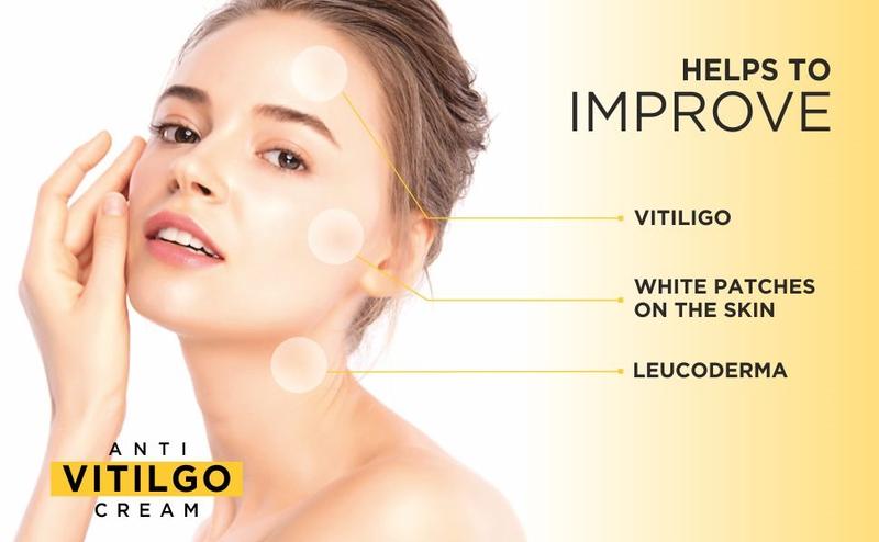 VENSIA Anti-Vitiligo Skin Care Cream 80g | Ayurvedic Herbal Support for White Patch Appearance & Skin Discoloration | Gentle & Safe for All Skin Types | Natural Ayurvedic Formula