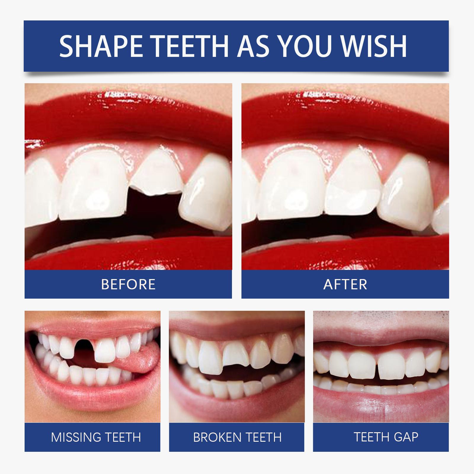 Solid Tooth Gel, Temporary Tooth Repair, Filling Cavities, Tooth Gap Filler, Denture Repair, Cosmetic Dental Glue