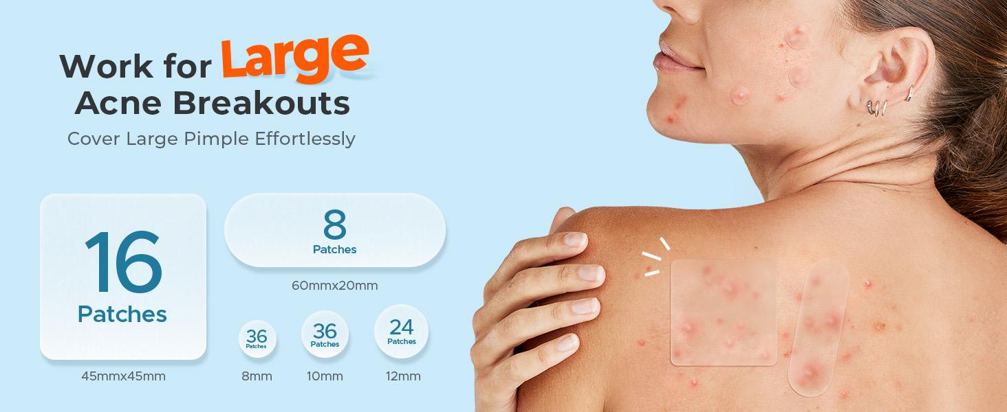 TKTK Hydrocolloid Bandages, 45 x 45 mm Large Pimple Patches for Face, XL Acne Patches for Body, Back, Forehead, Cheek Zit Breakouts, Big Hydrocolloid Patch (Square, Strip, Dot 5 Sizes 120 Count)