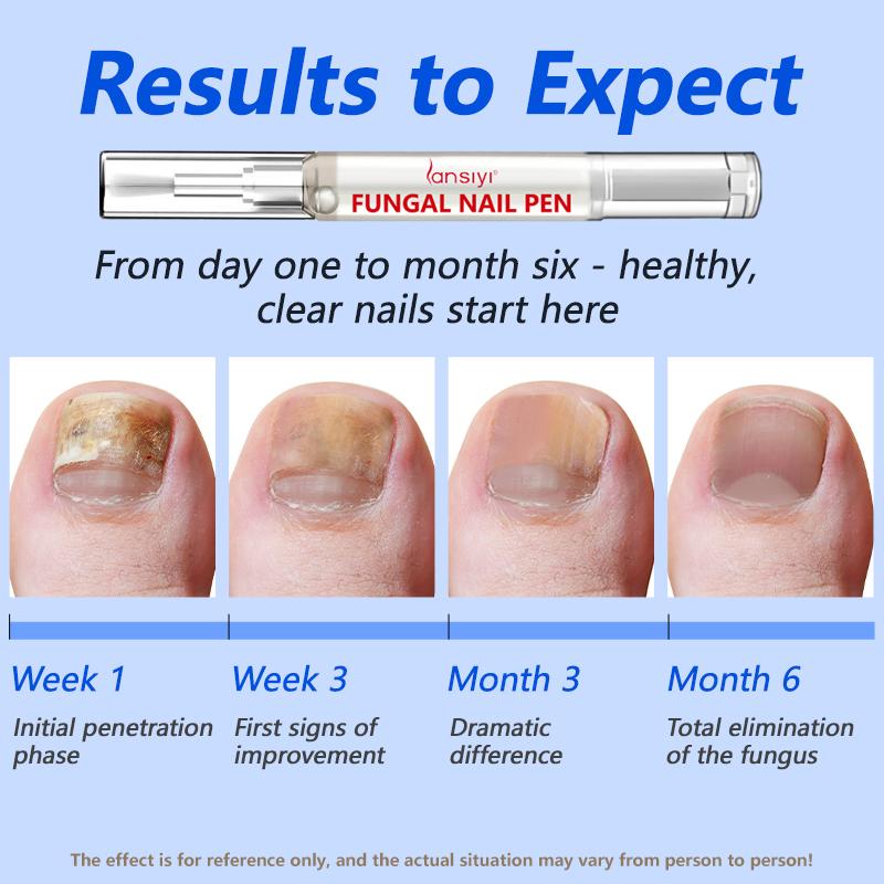 Lansiyi Fungal Nail Pen with Allicin & Undecylenic Acid, Nail Health Care Pen, Nail Fungus Care Pen for Solving Fungal Nails and Other Nail Problems, Nail Supplies Daily Care Nails Kit Set, Nail Tech Supplies,Self Care Tools Lansiyi Fungal Nail Pen with Allicin & Undecylenic Acid, Nail Health Care Pen, Nail Fungus Care Pen for Solving Fungal Nails and Other Nail Problems, Nail Supplies Daily Care Nails Kit Set, Nail Tech Supplies,Self Care Tools