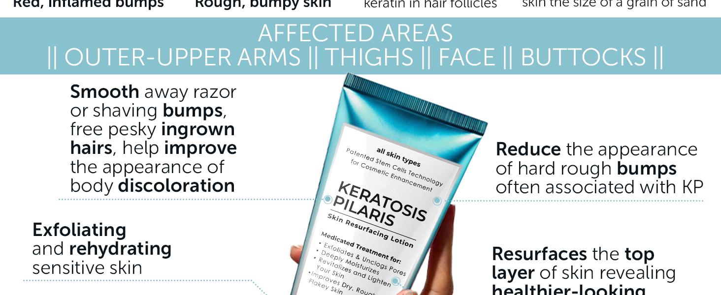 Keratosis Pilaris Treatment | Keratosis Pilaris Lotion with 10% AHA | Gentle Exfoliation For Strawberry Legs, KP & Ingrown Hairs | Smooth & Hydrating Body Lotion For Redness, Dry, Rough And Flaky Skin