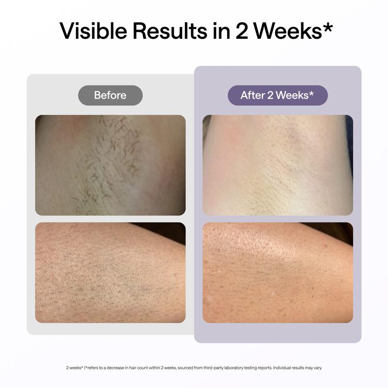 Ulike Laser Hair Removal Air 10 IPL Device with Ice-Cooling Contact Dual Lights Skin Sensor & SHR Mode for Comfortable Effective Results - Epilator