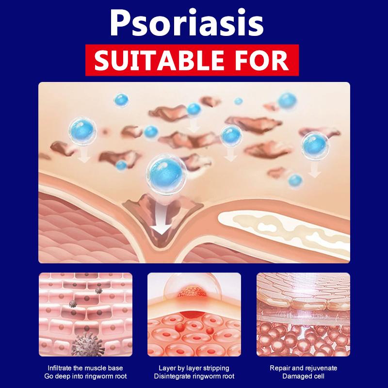 Extra Strength Psoriasis & Antifungal Cream 100% Natural Plant Extracts Fast Acting Relief for Itchy Red Dry Skin Fights Psoriasis Tinea Athlete's Foot Ringworm Deep Skin Repair Non-Recurring Safe for All Skin Types 20g Tube