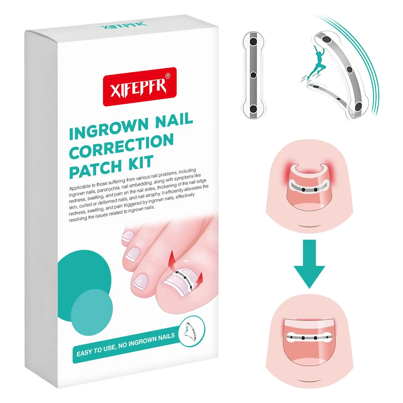 south moon Ingrown Toenail Treatment Kit, Professional Titanium Alloy Corrector for Curved Nail Repair and Pain Relief, Includes Patches & Tools, 0.59/0.67 in, Toenail Removal, Correction