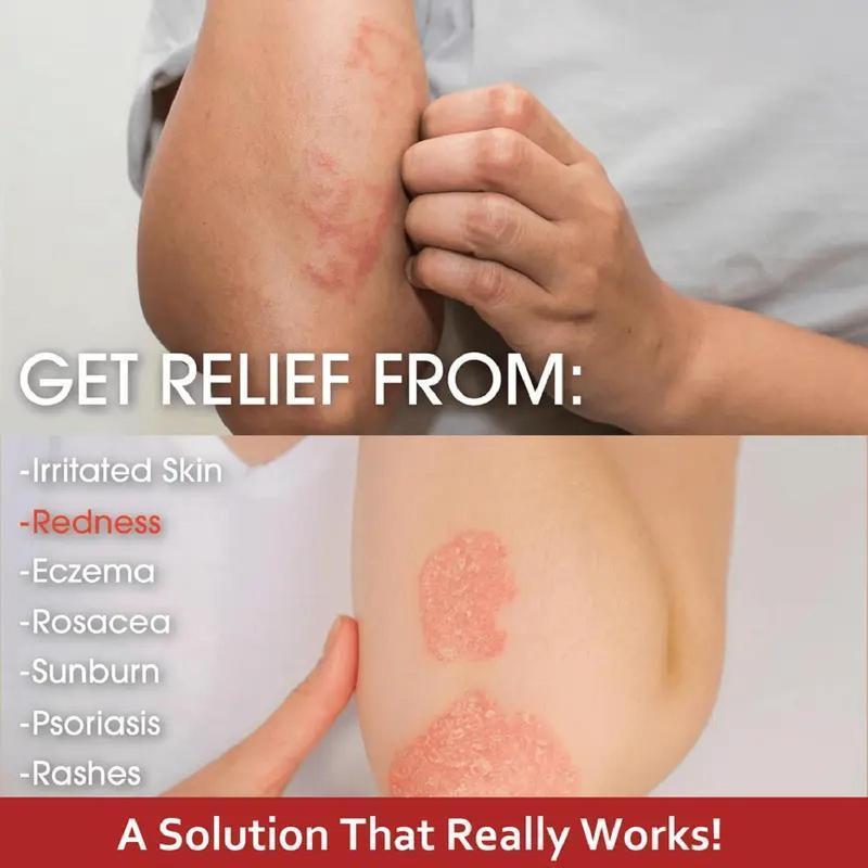 Premium All-Natural Herbal Soothing Cream for Psoriasis, Eczema, Dry & Sensitive Skin Relief | Plant-Based Itch Treatment Balm for Mosquito Bites - 30g