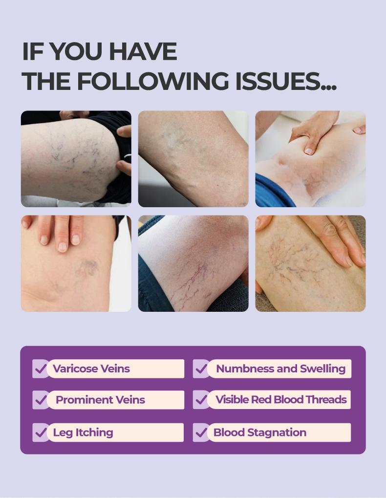 Buy 1 Free 1  Kreain Nature  Varicose Vein Treatment Cream Nature Ingredients Relieve Leg Pressure Centella Asiatica Root Extract dealsforyoudays