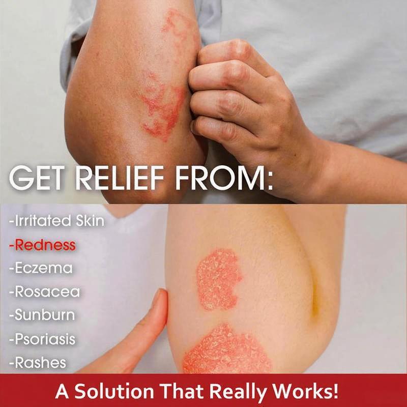 Umex All-Natural Plant-Based Herbal Relief Cream – Soothes Eczema, Psoriasis, Dry & Sensitive Skin | Ancient Botanical Formula for Whole Family Moisturizing Daily