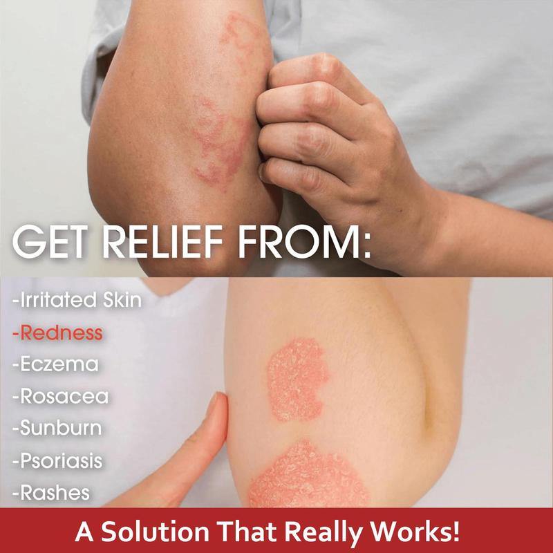 SanNuo Herbal Antibacterial Soothing Cream – Relieves Eczema, Psoriasis & Itching, Safe for Dry & Sensitive Skin, Zero Hormone & Fragrance-Free Creme for Eczema