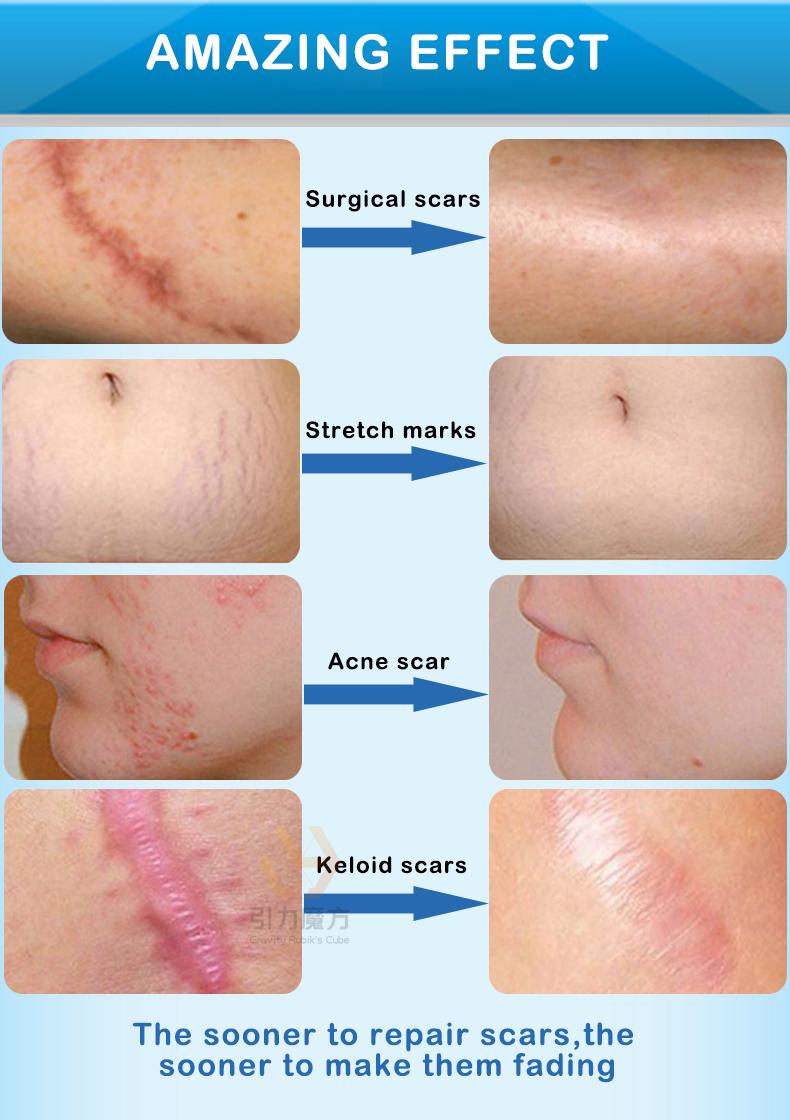 Scar Cream,Professional Scar Removal Gel,Suitable for scar removal treatment of post-operative scars,Caesarean section scars,Keloids,Burns,Acne