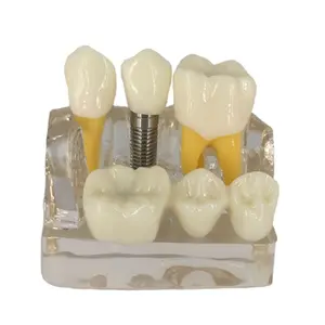 Transparent Dental Implant Model: 4 Times Magnification