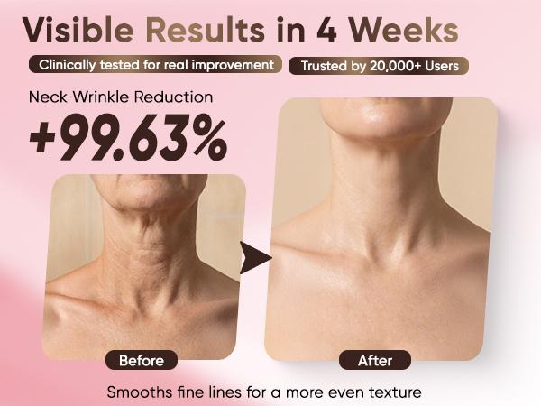 Misoour Neck Mask Set:Collagen Peptide Anti-Wrinkle Neck Mask + Astaxanthin Firming & Smoothing Serum|Reduce neck wrinkles, Moisturize and brighten,Firm and lift#TikTokShopBlackFriday