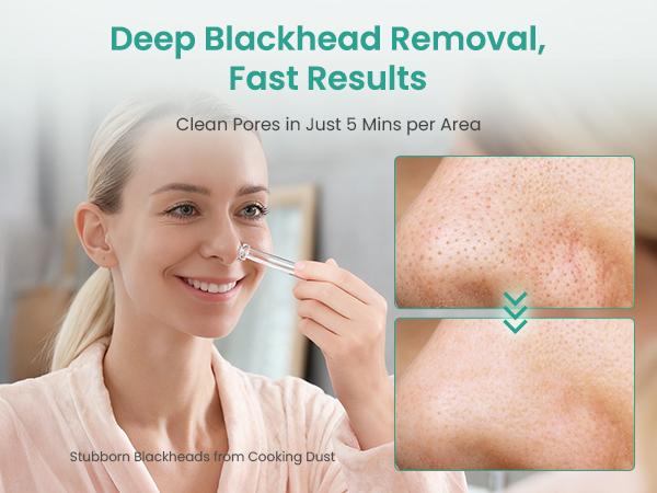 UNOISETION Diamond Microdermabrasion Machine- 3 in 1 Professional Facial Microdermabrasion Tool for Exfoliation & Blackhead Removal for Home Use Skin Care, Reduces Fine Lines, Boosts Serum Absorption