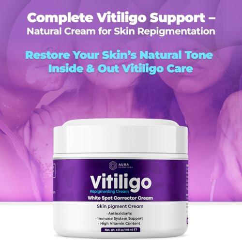 Vitiligo Cream for White Spots (4oz) - Repigmenting Cream with Polypodium Leucotomos and Melanocyte Support - Evens Skin Tone and Reduces Discoloration by Aura Dermacare