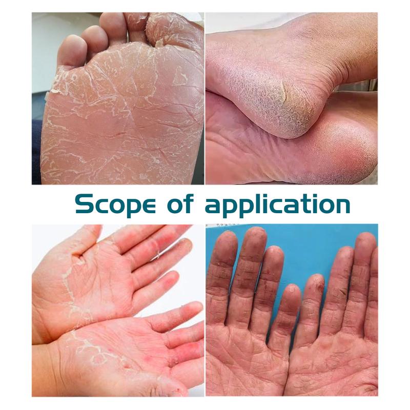 Clearzal  Dry Cracked Feet Repair UltraHydrating Hand and Foot Cream Crusty Moisturizer, 3.5 oz. Contains Urea, Salicylic Acid, for Dry, Chapped, Cracked Feet, Dead Skin Remover, For Thick, Cracked, Rough Skin , dead skin and dry skin cream