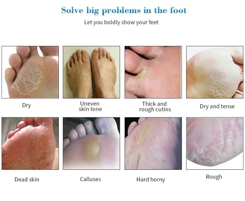 Exfoliating Foot Mask Pedicure Socks Dead Skin Remover for Heels Feet Peeling Callus Softening Smoothing Hydrating Botanical Extract Nourishing Foot Care Treatment Routine Unisex