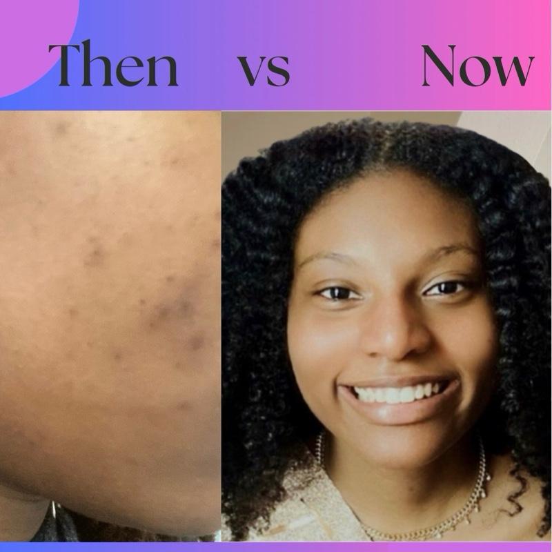 Lauderma Clarifying Acne-Prone Facial Bundle - Acne Prone Facial ...